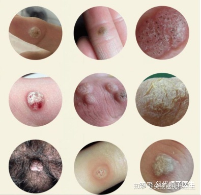 如何识别分辨尖锐湿疣？（多图重口慎入）
